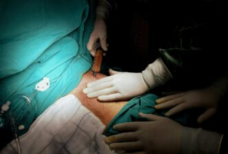 liposukcija scaled e1767691258498